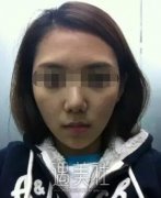 淄博中心医院整形科做玻尿酸除皱的果如何?我想改变自己~ width=
