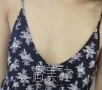 杨思琦丰胸案例：性感身材就是这么来的~ width=
