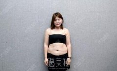 广州韩后吸脂案例：“大腹婆”逆袭“小腰精”！ width=