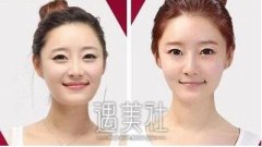 沧州假体垫下巴价格怎么样，什么原因会影响价格 width=