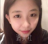 西京潘勇双眼皮案例果图：大眼睛真的是颜值的转换点~ width=