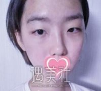 李东双眼皮案例：不做一次改变永远不知道自己有多美~ width=