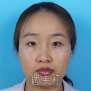 靳小雷做双眼皮怎么样，做了之后果真的很不错~ width=