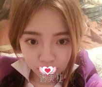 王涛隆鼻案例 五官立体全靠它 width=