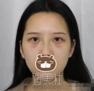 宿州天使整形医院双眼皮技术如何?案例及价目表一览~ width=