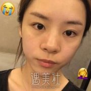 听说巫文云隆鼻很自然，然后我找他做了一个~ width=