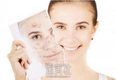 金华激光祛痘疤费用大概多少钱，小城市贵不贵？ width=