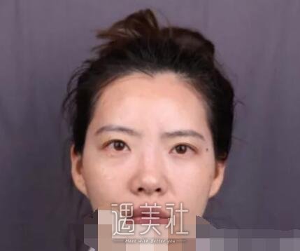 李德庆做鼻子真人案例