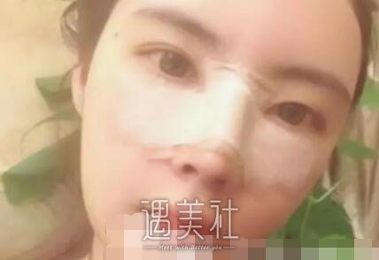 李德庆做鼻子真人案例