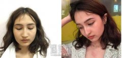 李青峰隆鼻案例 新疆妹子亲身讲述 width=