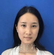 华西郭祥文隆鼻怎么样了，看看我的亲身体验吧~ width=