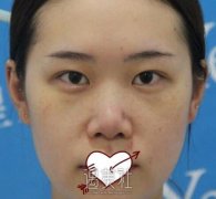 上海九院王涛隆鼻案例：隆鼻还有瘦脸的果？ width=