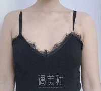 王明利自体脂肪丰胸整形案例 康康这个性感可人儿 width=