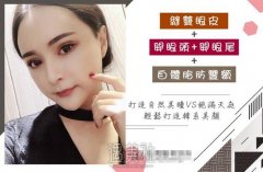上海九院杨娴娴双眼皮案例：恢复果棒棒哒！ width=
