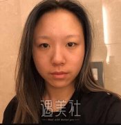 长沙美莱潘卫峰双眼皮案例：恢复得想到不错~ width=