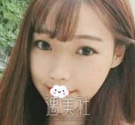 北京八大处杨欣隆鼻案例：鼻子好看，才是的皮囊！ width=