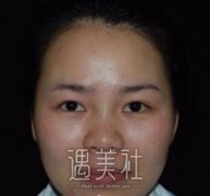 八大处陈文双眼皮案例：做完双眼皮，邂逅了很美的自己~ width=