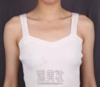 冯斌做自体脂肪丰胸案例 姐妹都说很值 width=