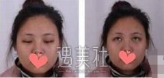 杜园园双眼皮案例 贵还是有道理的 width=