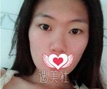 苏薇洁双眼皮案例 线条流畅弧度绝美 width=