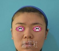 王旭明隆鼻案例  1-100天恢复记录附照片 width=