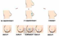 南京乳房上提术的价格是多少?价格和什么有关? width=
