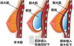 假体隆胸手术会不会留下明X的疤痕呢？术后该如何保养？ width=