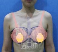 韦元强丰胸案例反馈 术后3个月恢复记录 width=