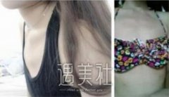 朱欣欣丰胸案例 90天恢复记录果分享 width=