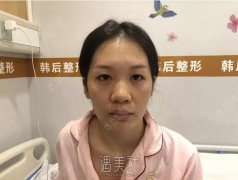 广州韩后隆鼻案例，拥有迷人小翘鼻~ width=