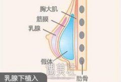 假体隆胸维持时间有多久？维持时间和哪些因素有关？ width=