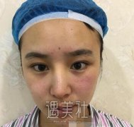 任冲双眼皮案例：眼神处处透露着自信~ width=