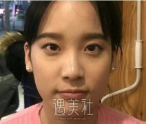 朱晓峰双眼皮修复案例 化妆师都说我眼睛好好看 width=