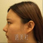 重庆王珍祥下颌角怎么样?有真实案例看看吗? width=