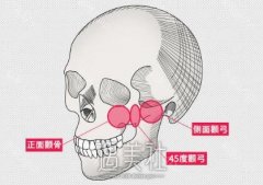 颧骨内推对比果照片|颧骨内推果好吗？ width=