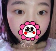 秦宏伟双眼皮案例：眼睛大大的很是招人喜欢呐~ width=