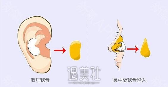 自体耳软骨隆鼻果好吗|自体耳软骨隆鼻优缺点盘点~