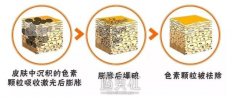 上海镭射祛斑多少钱?受哪些因素的影响喃? width=