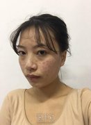 光子嫩肤前后对比照片|光子嫩肤真实案例分享~ width=