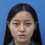 广东省二院整形科徐翔开眼角怎么样?有案例吗 width=