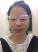 杨亚益双眼皮修复案例：收费贵是有原因的哦! width=