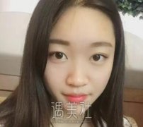 北京巫文云隆鼻案例：这个鼻子朋友看了都赞不绝口！ width=