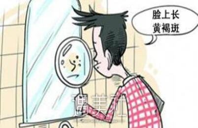 激光去黄褐斑
