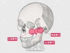 较为担心做完颧骨内推或降低会导致面部下垂怎么办？ width=