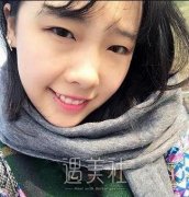 青岛伊美尔5s双眼皮案例：恢复得不错hin4满意啊! width=