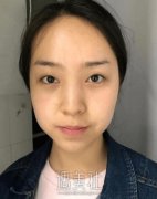 全切双眼皮7天恢复过程图片|全切双眼皮真实记录贴~ width=