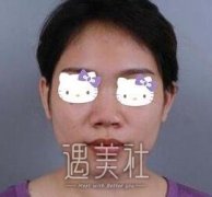 巫文云隆鼻案例：这鼻型告诉你什么叫多方位无死角~ width=