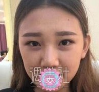 马显杰隆鼻案例：隆鼻手术后，找到了更的自己！ width=