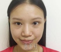 成都米兰柏羽隆鼻案例 拯救塌鼻不立体 width=