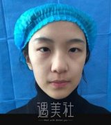 郑大一附院刘林嶓双眼皮案例：眼中流淌着自信~ width=